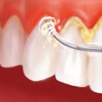 Điều trị viêm nướu - Lấy vôi răng